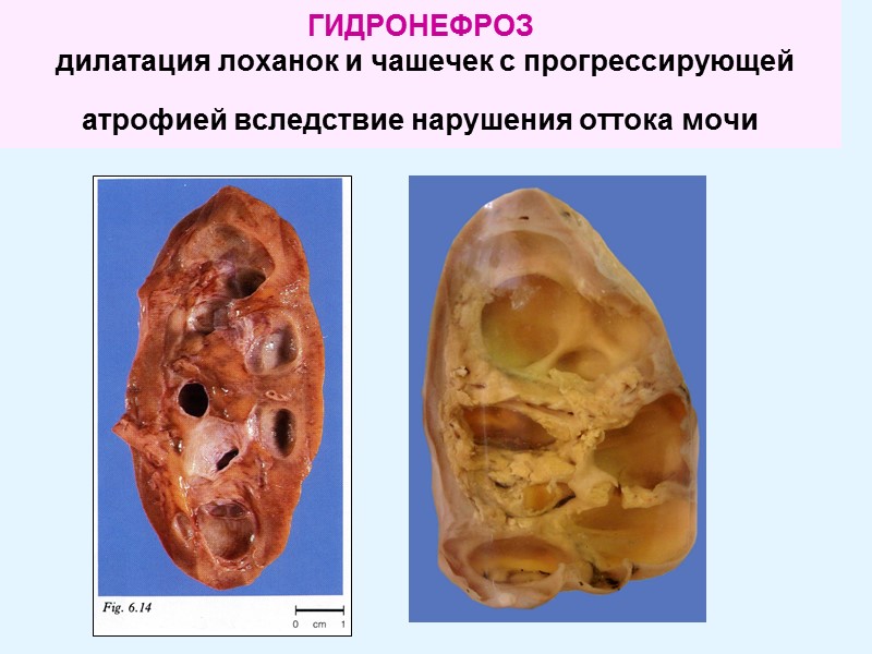 ГИДРОНЕФРОЗ    дилатация лоханок и чашечек с прогрессирующей атрофией вследствие нарушения оттока